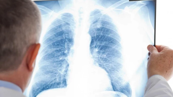 Screening pulmonar gratuit în raionul Călărași